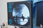 В Самарской области впервые выпрямили ноги девочке с эстетической проблемой